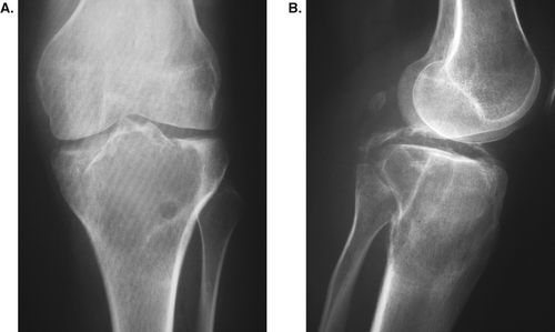 A 25-year-old woman with cylinder form giant cell tumor of 220 cm3. There was an intra-articular fracture preoperatively. Full weight bearing was allowed at 6 weeks after curettage.