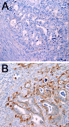 Figure 3.  Immunohistochemical analyses of EGFR in primary colorectal tumors. (A) Negative staining in colorectal cancer cells and surrounding tissues. (B) Positive membranous staining in more than 10% of colorectal cancer cells (original magnification ×20), and mostly negative staining in surrounding tissues.