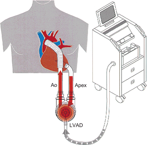 Figure 1.  Schematic situs of a “first generation” ventricular assist device (pulsatile VAD).