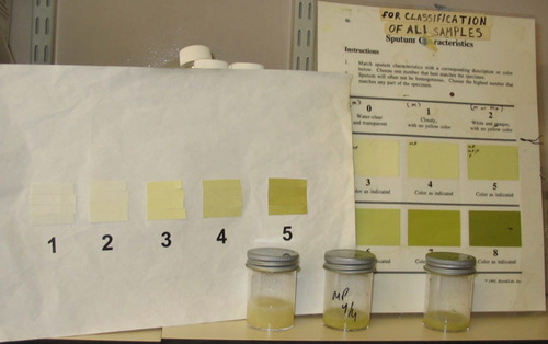 Figure 2 Sputum color chart used at Queen Elizabeth Hospital, Birmingham, UK. In symptom-based diary cards, sputum color is graded 1–5. Samples graded 3–5 indicate increasing neutrophilic infiltration and concomitant elastase activity.
