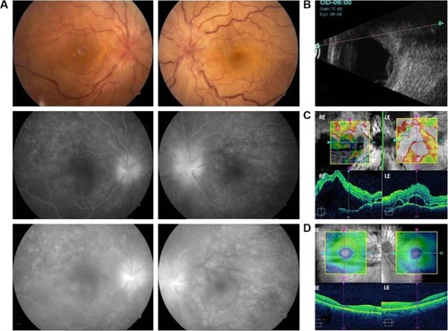 Figure 1 (A) A 30-year-old female. BCVA 20/200 in both eyes. Serous retinal detachments, pinpoint leaks, disc hyperflourescence, and pooling of dye. (B) Ultrasonography shows choroidal thickening and serous retinal detachment. (C) OCT – shows large serous retinal detachments with subretinal septae and RPE undulation. (D) Two and a half months after initiating treatment, the retina is reattached. BCVA is RE 20/20 and LE 20/25.