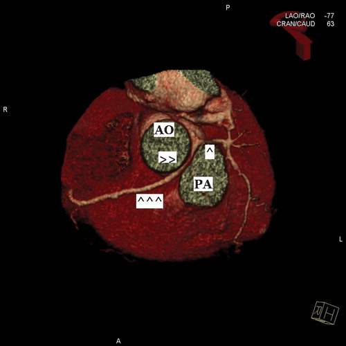 Figure 2. Three‐dimensional reconstruction of the heart by CTA demonstrating common single left‐sided coronary ostium giving rise to the left main coronary (single arrow) and proximal right coronary (double arrows) segments. Note the inter‐arterial course of the latter between the aorta (Ao) and pulmonary artery (PA), as well as the relatively narrowed diameter of this segment when compared to the normal‐caliber mid vessel (triple arrows).