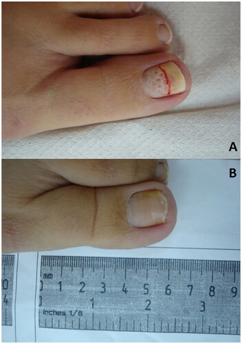 Figure 6. Photographs showing nail drilling of a toenail. (A) the toenail Shortly after nail drilling and application of topical antifungal. (B) Healthy nail after 6 months, with clear nail observed.