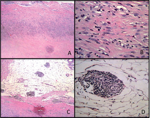 Figure 3. A. Histological view of the soft tissue mass at the interface between the necrotic material (on the joint side) and inflammatory cells. Hematoxylin and eosin (HE), 40×. B. Enlargement of A with inflammatory cells consisting mainly of macrophages and lymphocytes along with plasma cells and eosinophils. HE, 200×. Several lymphocytic aggregates were observed at low magnification (panel C; HE, 40×) and at high magnification (panel D; HE, 200×).