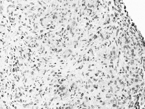 Figure 2.  Immunostaining for CD3: an interstitial granuloma with infiltrating T lymphocytes (CD3+).