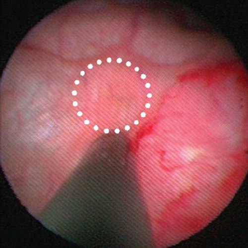Figure 1. Cystoscopy image of a Lipiodol injection in the bladder mucosa. The tip of the injection needle is in the centre of the picture with the tumor to the right and a formation of an injection papule to the left (white circle).