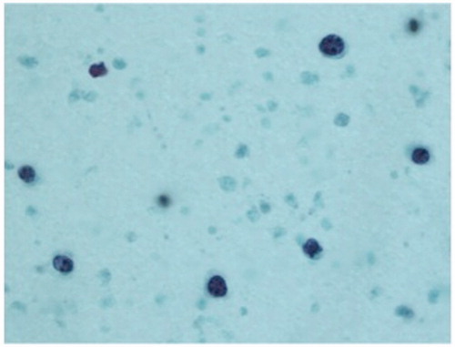 FIGURE 2. Cytologic specimen from an undiluted vitreous sample in a patient with primary vitreoretinal lymphoma and central nervous system lymphoma, demonstrating atypical lymphoid cells with pleomorphic nuclei and scant cytoplasm. Flow cytometry of this specimen was CD19 and CD20 positive with kappa light chain expression consistent with B-cell lymphoma.