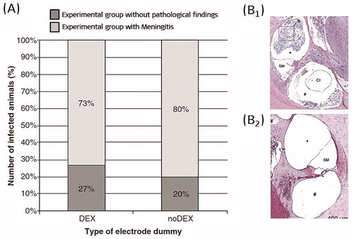 Figure 19. Experimental group implanted with DEX eluting electrode developed meningitis in 4/15 (27%) subjects, and the experimental group implanted with non-eluting electrode dummies developed meningitis in 3/15 (20%) subjects (A) [Citation25]. Reproduced by permission of Taylor and Francis Group. Mid-modiolar section of the cochleae showed the presence of inflammatory cells in the subjects that got meningitis (B1), and no presence of inflammatory cells in the subjects that did not get the meningitis infection (B2) [Citation26]. Statistical tests: Mann-Whitney U test and Fisher’s exact test (p < .05). Reproduced by permission of Elsevier B.V.