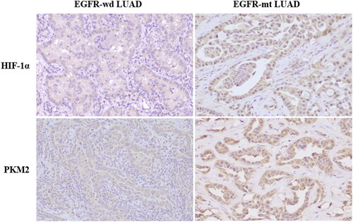 Figure 3. Different expressions of HIF-1α and PKM2 in EGFR wild type (EGFR-wd) and EGFR mutation (EGFR-mt) lung adenocarcinomas.
