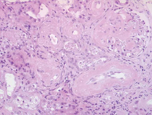 Figure 2.  Light microscopy. Amyloid deposits in glomerulus (nodular mesangiocapillary pattern) and vascular walls (HE ×10).