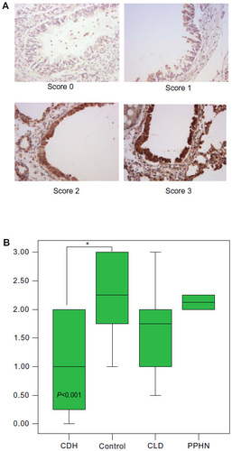 Figure 5 The BDNF representative slide staining (×400) scores (0–3) (A) and the corresponding intensity staining scores (B) at the bronchiole level. The control group had intensity scoring R 1.00–3.00, IQR 1.75–3.00, M 2.25, and the CDH group R 0.00–2.00, IQR 0.25–2.00, M 1.00; CDH group has significantly lower scores, P<0.001, CI 0.40–1.90. Scores for CLD and PPHN groups were not significantly different versus control group. *Shows statistical significance as indicated.