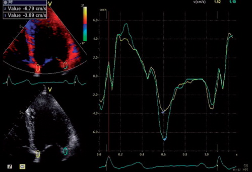 Figure 1. Representative colour-coded TDI 4-chamber view of the left ventricle in which 5 × 10 mm regions of interest were placed at the insertion of the anterior and posterior mitral leaflets, respectively. Time-dependent annular tissue velocities are depicted on the right. Peak early mitral relaxation velocities, e’, (blue crosses) were measured in the septum and lateral free wall.