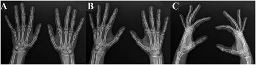 Figure 1. 1 A. Anteroposterior, 1B. oblique and 1 C. lateral radiographs of bilateral hands demonstrating mild degenerative carpal and interphalangeal joint changes with no other osseous or soft tissue abnormalities.