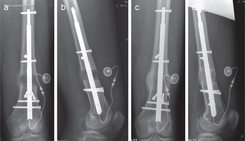 Figure 4. AP and lateral radiograph when lengthening was completed (panels a and b) and 6 weeks later (panels c and d) (nail group: pair 3).