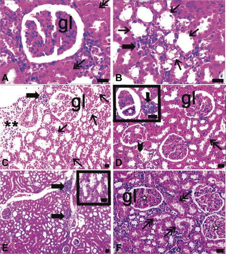 FIGURE 5. Light microscopy of kidney in the ovariectomy and diabetes (A, B) and ovariectomy and sepsis (C, D), and diabetes and sepsis group (E, F). gl, glomerulus; asterisk, glomerulus with segmental necrosis; double asterisks, inflammatory cell infiltrations at diffuse form; thick arrow, inflammatory cell infiltrations at nodular form; thin arrow, cells of distal tubules with hydropic degenerations ; arrow with double head and inset of E, proximal tubules with apical degenerations, asterisk with white filling, glomeruli which their capillaries were congested arrowhead, erythrocytes in inter-tubular area; dye: hematoxylin–eosin; magnification bars: 40 μm.