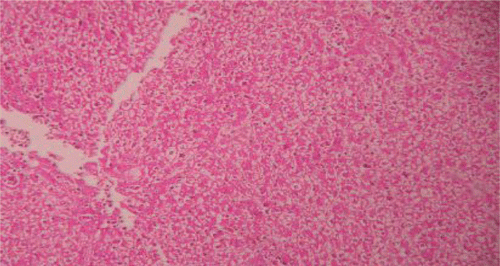 Figure 2.  Liver section of paracetamol rats shows necrosis, ballooning degeneration and massive infiltration of lymphocytes.
