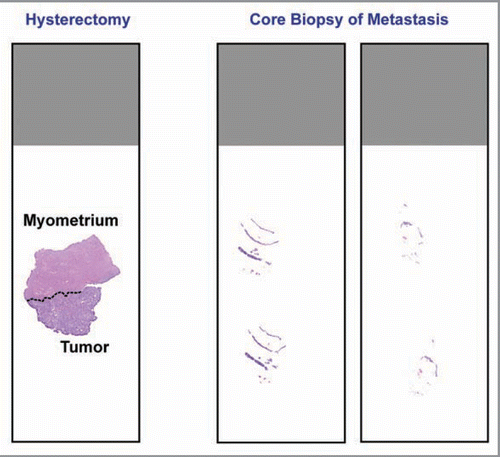 Figure 2 Comparison between tissue obtained from a primary hysterectomy specimen and tissue obtained from core needle biopsy at the time of recurrence. Recurrence tissues are much smaller, have less tumor cells, and commonly consist of tumor cells admixed with stroma. This latter feature may necessitate the use of laser capture microdissection prior to PCR-based molecular diagnostics testing.