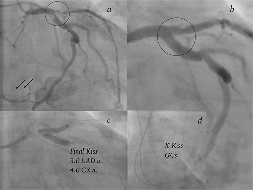 Figure 4. Case 4. Caudal RAO views before and after LAD/CX artery stenting. Final kiss balloons view (“V-Pattern”), only the GCs X-kissed.