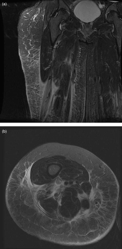 Fig. 1a. and 1b.  Coronal STIR and Axial T2 fat saturated MRI images through the thigh showing increased signal involving the subcutaneous fat (cellulitis), superficial muscle fascia (fasciitis) and biceps femoris muscle (myositis) and also extension of the signal to the neurovascular bundle.