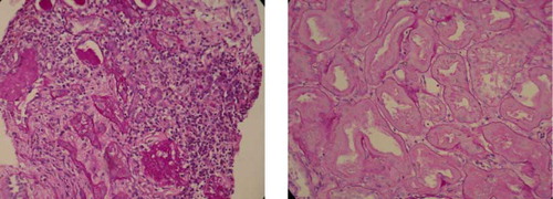Figure 1.  (a) H&E stain of kidney biopsy shows mononuclear cells infiltration of the interstitium, suggesting interstitial nephritis. (b) H&E stain of kidney biopsy shows tubular necrosis.