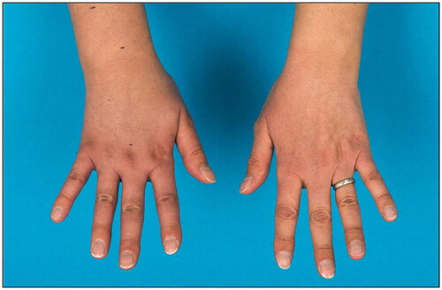 Figure 3. Follow- up after 8 months showed complete regression of the edema at the wrist and only a minor lymphedema of the back of the hand.