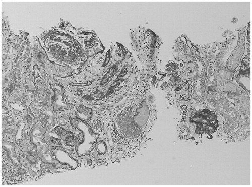 Figure 1. Light photomicrograph, low power view, showing sclerosed glomeruli (both segmental and global) and tubular atrophy.