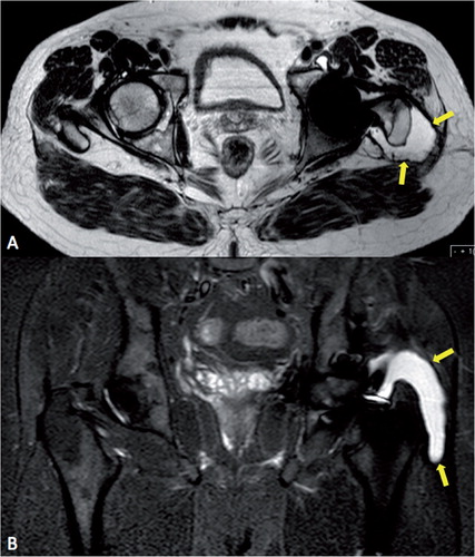 Figure 4. Example of abductor stripping secondary to pseudotumor (marked with arrows). A. Axial image. B. Coronal image. A pseudotumor can be seen traversing the posterior hip around the greater tuberosity onto its lateral aspect, which is now void of abductor tendon insertion.