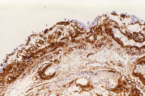 FIGURE 2.  Immunohistological test with prot AA antiserum was positive in bladder