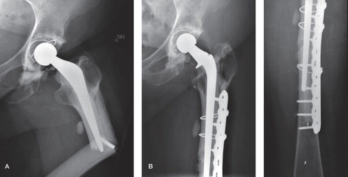 A. A 72-year-old women (patient 6) who was operated with a cemented Exeter THA with a standard-length femoral stem, and who sustained a periprosthetic femoral fracture. B. The same patient after reoperation with stem revision and plate osteosynthesis.