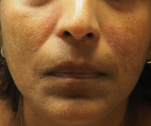 Figure 1 Acute cutaneous lupus erythematosus (ACLE) characterized by violaceous to erythematous patches and thin plaques involving the malar cheeks. Importantly, this pathognomonic “butterfly rash” of lupus strikingly spares the nasolabial folds helping to distinguish ACLE from disease mimics.
