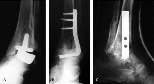 Figure 1.  A 63-year-old man (case 3) with long-standing RA and a preoperative varus deformity of the ankle of 20 degrees. A. After implantation of an LCS prosthesis. There is a persistent varus deformity and edge-loading of the prosthesis. B and C. After conversion to tibiotalar arthrodesis. The arthrodesis was stabilized by a humeral blade plate, implanted at the lateral side. Debris originating from the edge-loading of the metallic components is visible at the arthrodesis site.