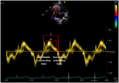 Figure 7. Myocardial Performance Index—Tei index. The Tei index obtained by Tissue Doppler is illustrated in the figure. Tei index = the sum of isovolumic contraction and relaxation time divided by ejection time (a − b/a).