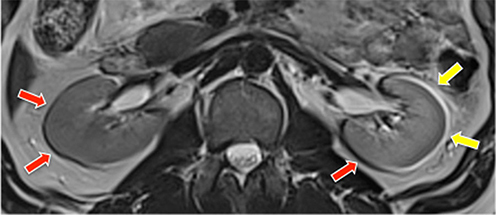 Figure 5 At the water-fat interface, there is a chemical shift artifact. The axial T1-weighted GRE MR image shows a dark rim on one border of the kidney and a bright rim on the opposite edge (indicated by white solid arrows), an artifact caused by the difference in fat and water precessional frequencies [Courtesy Allen D Elster, MRIQuestions.com].Citation22