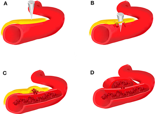Figure 1 Brain trauma leads to rupture of the intima, media, and adventitia of the blood vessel (A and B), forming an organized hematoma cavity (C). When the hematoma forms outside the arterial wall, it continues to communicate with the injured vessel, thus predisposing it to re-bleeding (D).