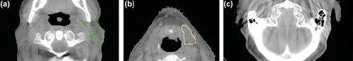 Figure 3. Axial CBCT slices with examples of propagated deformed contours evaluated as acceptable. (a) Left parotid with minor inconsistent segmentation. (b) Left submandibular gland contour going slightly into level II nodal volume. (c) Inconsistent overlap between spinal cord (cyan) and brain stem (light green).