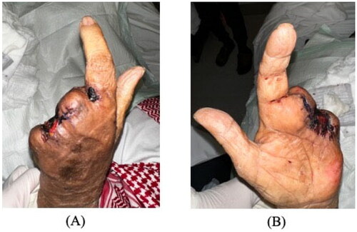 Figure 3. Ten days after middle finger amputation, prior to discharge. Marked improvement of swelling and erythema in the palm is seen after starting antifungal therapy.