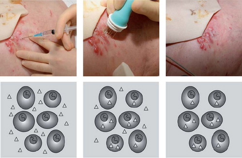 Figure 2. Electrochemotherapy. In the right panel, bleomycin is injected at the tumour site, at a concentration of 1000 IU/ml (1 U/ml). In the middle panel the electric pulses are subsequently applied, cells are permeabilised and the drug enters. In the left panel the cells reseal after a few minutes and the extracellular drug is washed out while the internalised molecules remain trapped intracellularly.