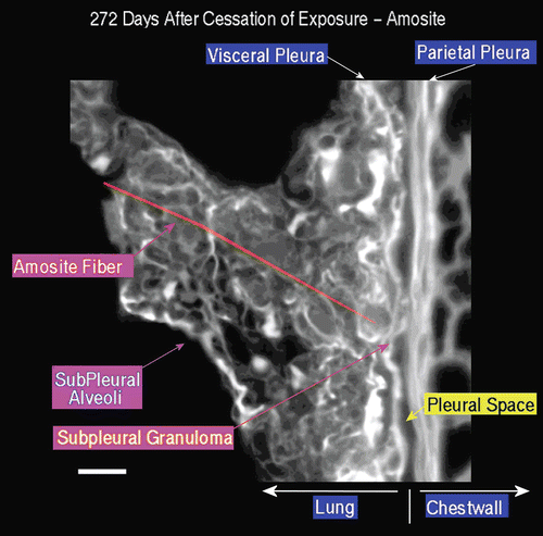 Figure 17.  View of the pleural space from an animal exposed to amosite asbestos at 272 days postexposure. An amosite fiber ~ 39 µm in length is observed within a subpleural granuloma. The right edge of this long fiber pierces the subpleural capsule. The thicker bright white matrix is indicative of a fibrotic thickening of the visceral pleura.