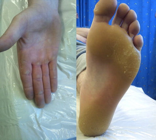 Figure 1. Hyperkeratosis of right lateral palm and phalanges (left hand side). Hyperkeratosis of left plantar surface of foot (right hand side) – similar findings on right foot (not shown).