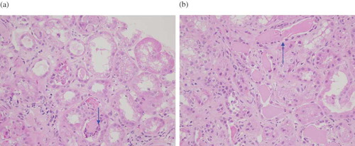 FIGURE 1. (a) The casts are surrounded by mononuclear cells, multinucleated giant cells, and neutrophils (hematoxylin and erosin stain, ×400). (b) A low-magnification photograph depicts large eosinophilic hyaline casts in the dilated tubular lumina (hematoxylin and eosin stain, ×400).
