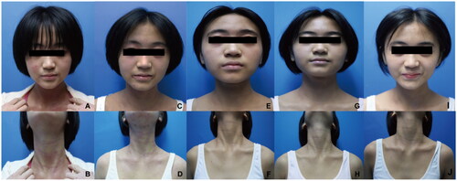 Figure 1. (A, B) Face and neck lesions before treatment with dupilumab. (C, D) no significant improvement in the skin lesions of the face and neck after 12 weeks of dupilumab treatment. (E, F) Clinical improvement after 4 weeks of upadacitinib. (G, H) Marked improvement with clearing of face and neck lesions after 8 weeks of upadacitinib. (I, J) Clinical complete resolution after 12 weeks with upadacitinib without recurrence.