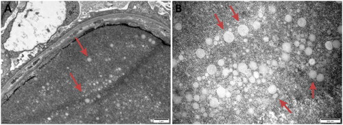 Figure 9. Electron microscopy: Vacuoles were observed in the glomerular capillary lumen.
