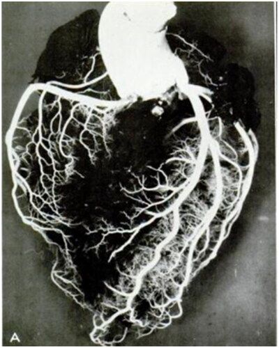 Figure 3. Anterior surface of the heart, after injection of plastic materials (Geon Latex 576 and Neoprene 842A). The obtained vascular cast clearly resembles the iconic shape of the heart. Reproduced from Baroldi G, Scomazzoni G. Coronary Circulation in the Normal and Pathological Heart. Washington, DC: Office of the Surgeon General, Department of the Army; 1967.