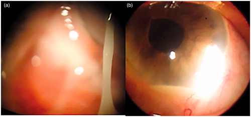 FIGURE 1. Ocular Biomicroscopy: (a) Right Eye - Purulent discharge – (b) Right Eye – Hypopyon.