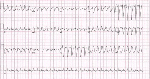 Figure 1. Patient's initial EKG on admission. Patient was in a wide complex tachycardia (HR 195, QRS 164 ms).