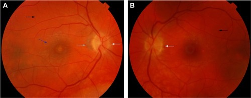 Figure 4 Color retinal photographs of right (A) and left eye (B) during the convalescent phase of VKHD, showing sunset glow fundus with pale optic discs (white arrows) and bright-orange choroids (black arrows). Note the peripapillary atrophy (gray arrow) and macular scaring (blue arrow) in (A).