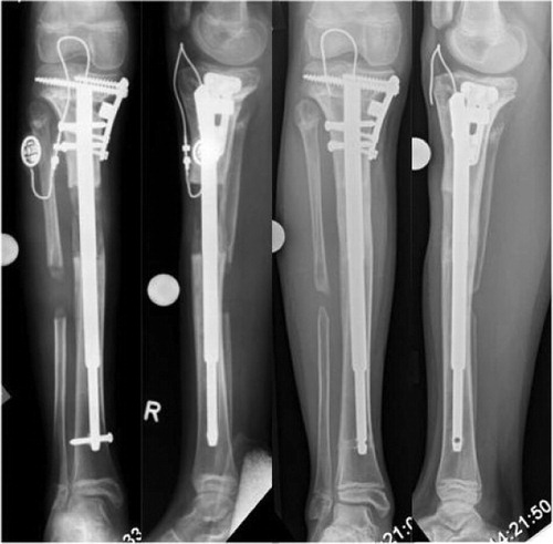 Figure 5. Anteroposterior and lateral radiographs 3 months (left) and 9 months (right) after surgery.