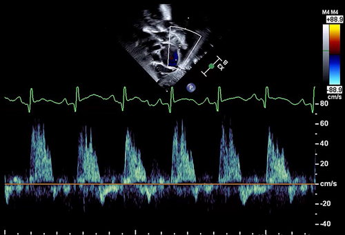 Figure 7 Pulsed-wave Doppler of the abdominal aorta demonstrates reversal of flow during diastole.