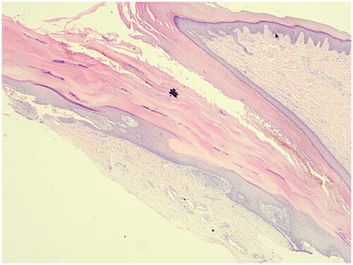 Figure 2. Nail biopsy. A nail biopsy showed hyperkeratosis, parakeratosis, and neutrophils in the nail plate, suggestive of nail psoriasis (HE staining: ×40).