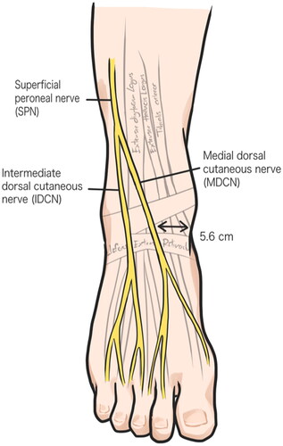 Figure 1. Illustration of superficial peroneal nerve anatomy and its branches, medial dorsal cutaneous and intermediate dorsal cutaneous nerves.